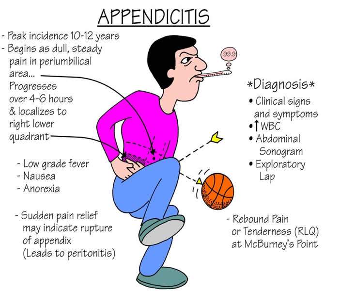 Appendicitis Causes, Symptoms, Treatment, Diagnosis and Prevention