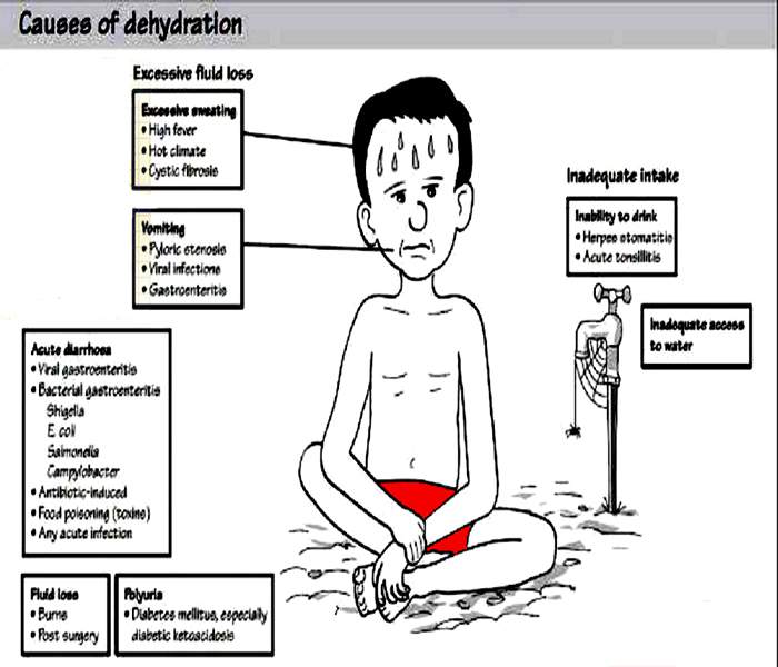 severe dehydration in children