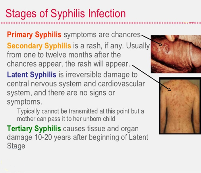 Natural Therapy for Syphilis :: Galleria Health and Lifestyle, Nigeria